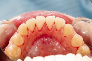 Surgery for Periodontal Disease – What to Know