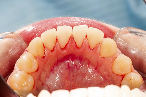 Periodontitis – Types of Surgical Treatments