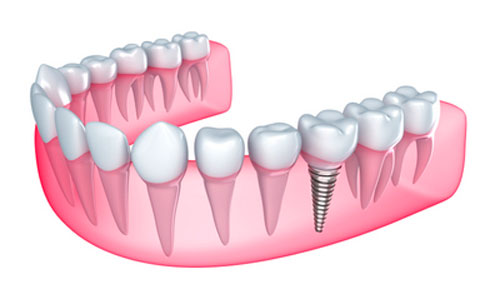 Ideal Candidates for Dental Implants