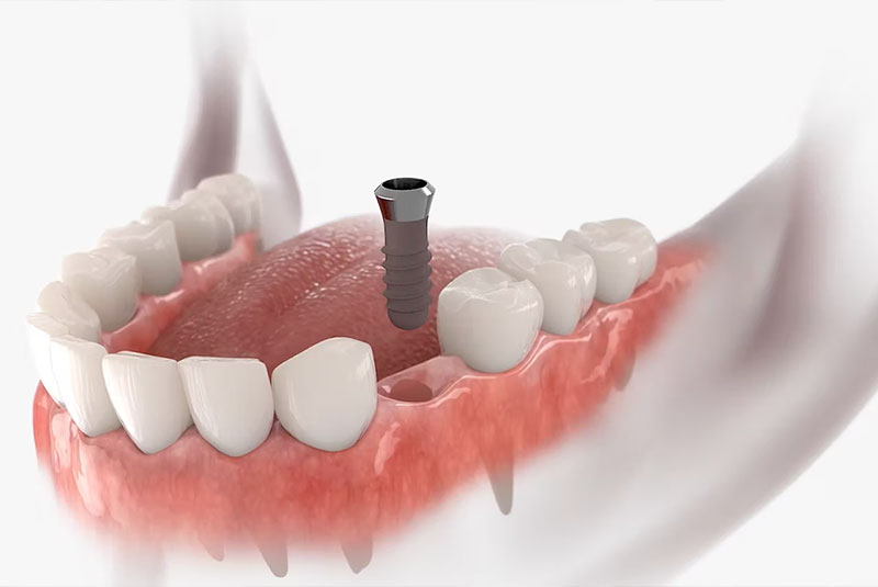 model of a implant going into a mouth