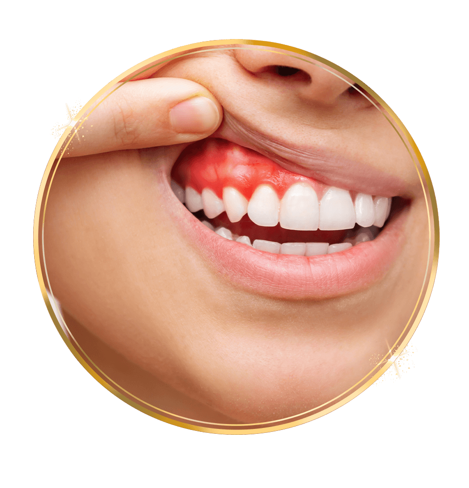 Gum Disease