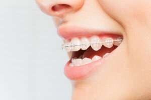 How Do I Care For My Teeth and Gums When I Am In Braces?