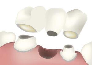 Caring for the Gums Under a Dental Bridge