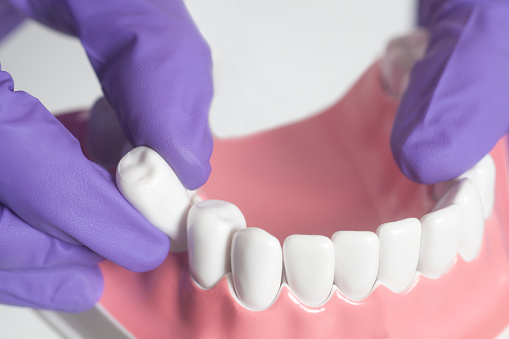 What is Tooth extraction