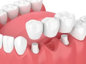 Benefits Of Dental Prosthetics