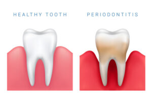 Is there a Difference between Regular Tooth Cleaning and Periodontal Maintenance