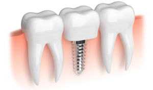 How Can I Replace My Missing Teeth?